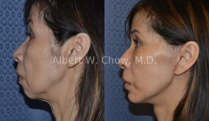 Before & After Chin Augmentation Case 49 View #1 View in San Francisco, CA