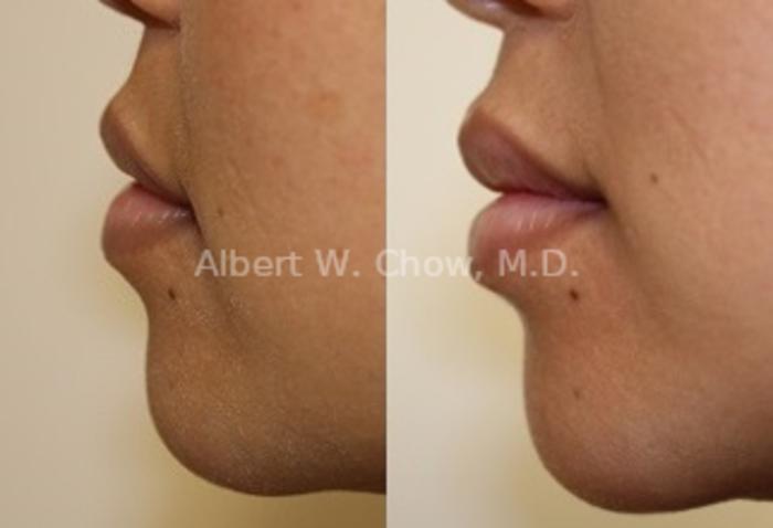 Before & After Lip Filler Case 105 View #1 View in San Francisco, CA
