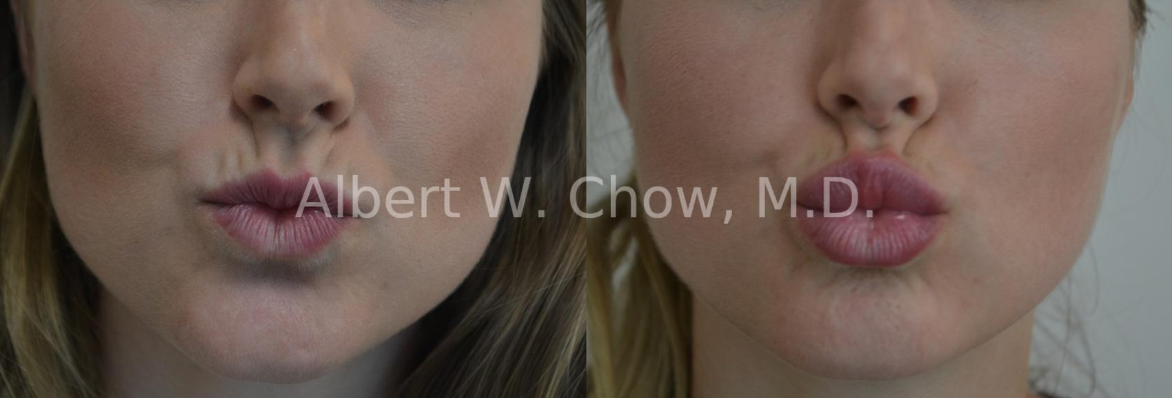 The Ultimate Guide To Botox/lip Fillers - Ronald Rasi, D.d.s. - Roseville, Ca thumbnail