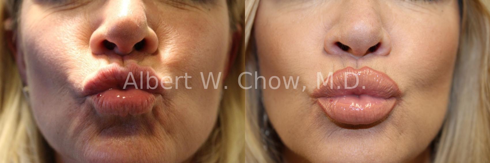 Before & After Lip Filler Case 45 View #1 View in San Francisco, CA