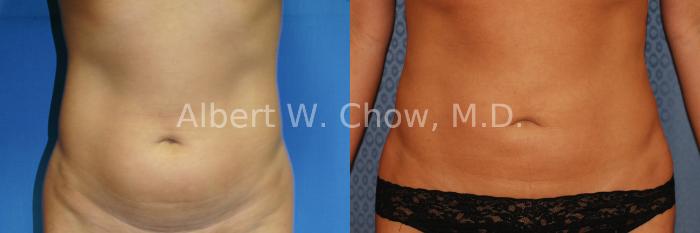 Before & After Liposuction Case 12 View #1 View in San Francisco, CA