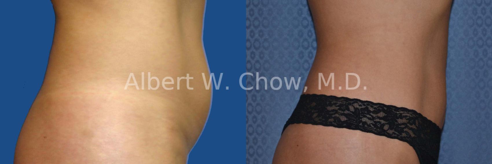 Before & After Liposuction Case 12 View #2 View in San Francisco, CA