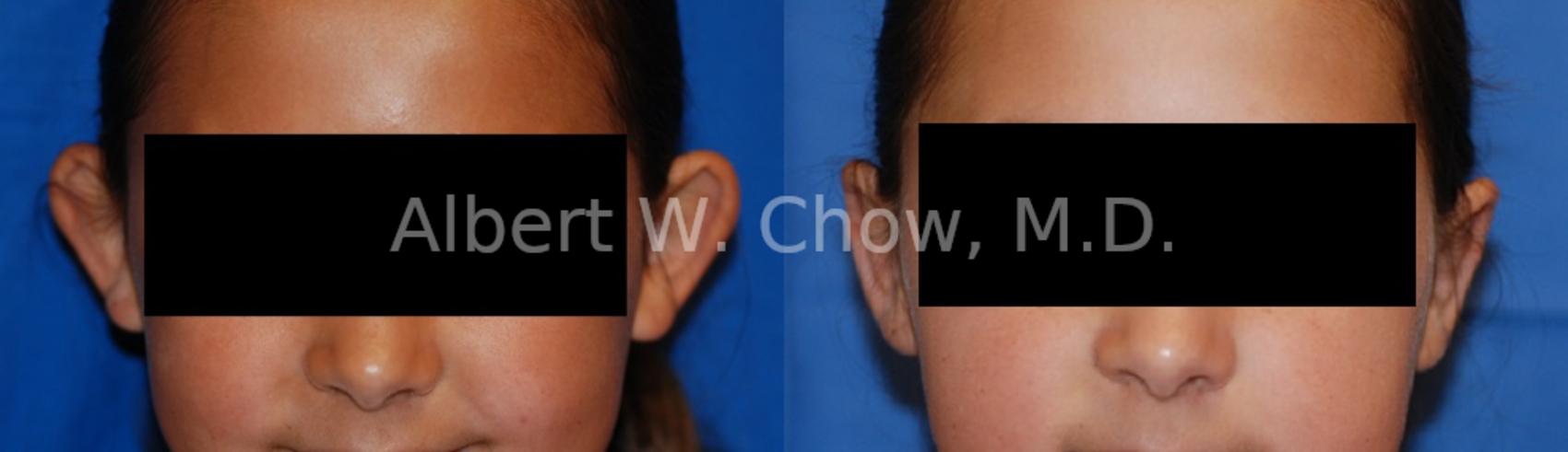 Before & After Otoplasty Case 76 View #1 View in San Francisco, CA