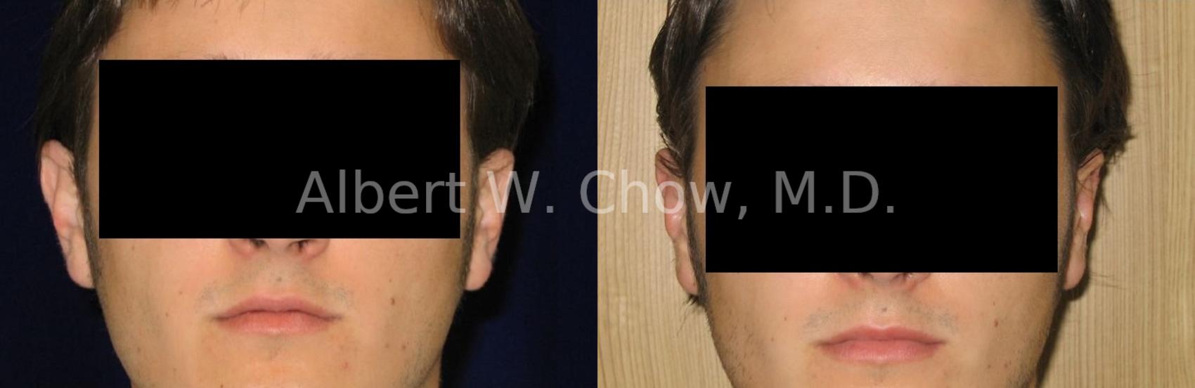 Before & After Otoplasty Case 80 View #1 View in San Francisco, CA