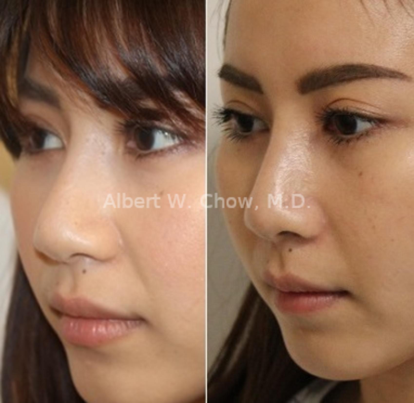 Before & After Revision Rhinoplasty Case 113 View #1 View in San Francisco, CA
