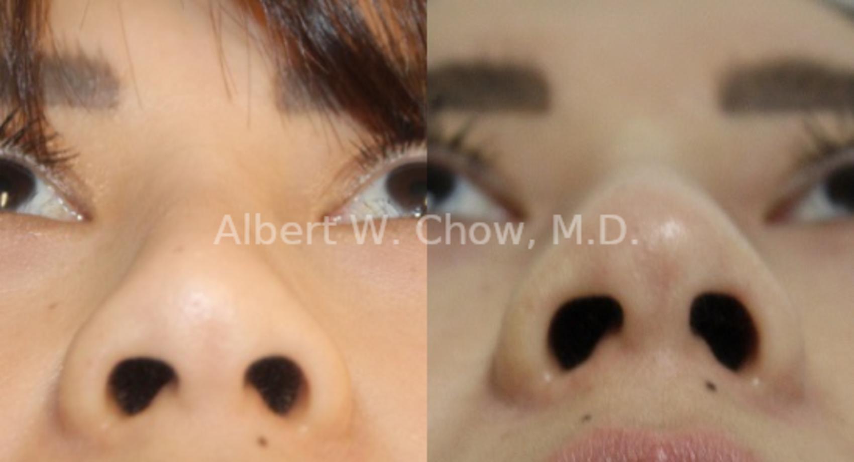 Before & After Revision Rhinoplasty Case 115 View #1 View in San Francisco, CA