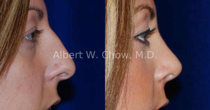 Before & After Rhinoplasty Case 13 View #1 View in San Francisco, CA