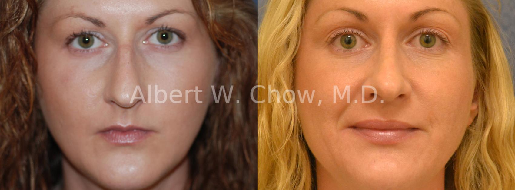 Before & After Rhinoplasty Case 14 View #1 View in San Francisco, CA