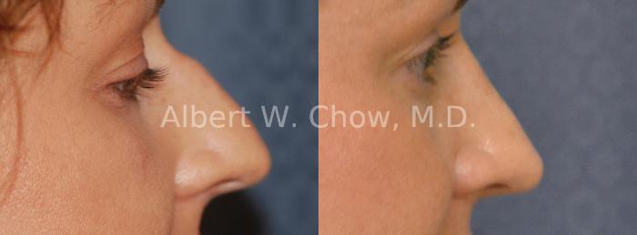 Before & After Rhinoplasty Case 14 View #2 View in San Francisco, CA