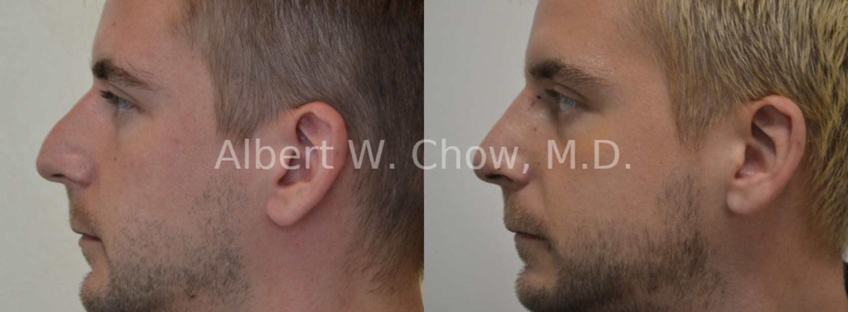 Before & After Rhinoplasty Case 27 View #1 View in San Francisco, CA