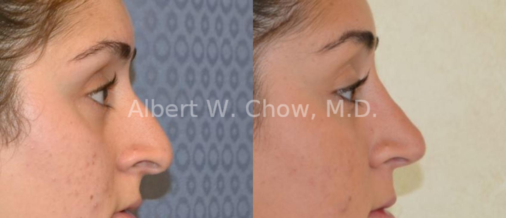 Before & After Rhinoplasty Case 36 View #1 View in San Francisco, CA