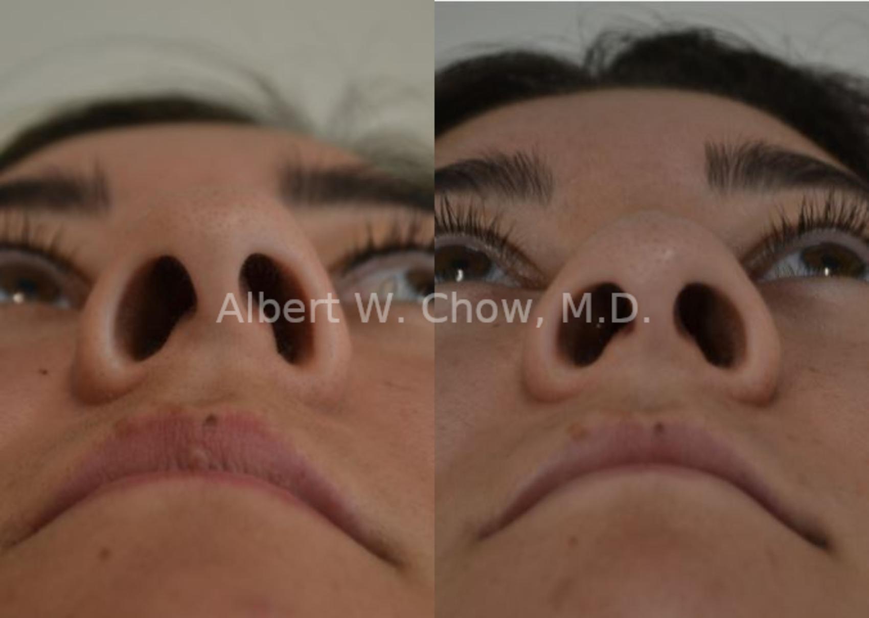 Before & After Rhinoplasty Case 44 View #1 View in San Francisco, CA