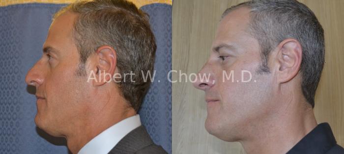 Before & After Rhinoplasty Case 47 View #1 View in San Francisco, CA