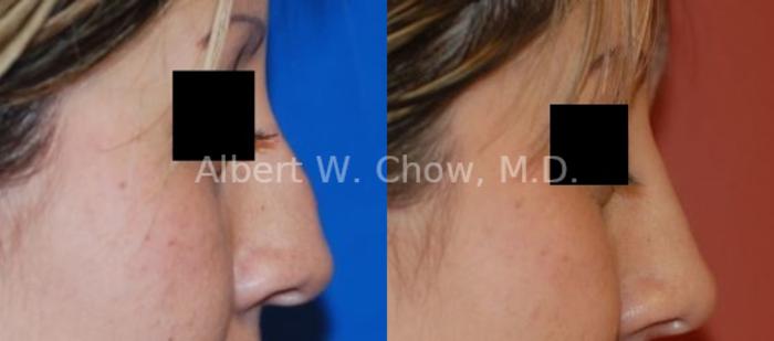 Before & After Rhinoplasty Case 50 View #1 View in San Francisco, CA