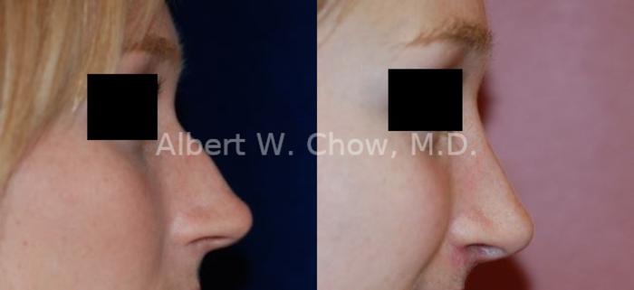 Before & After Rhinoplasty Case 51 View #1 View in San Francisco, CA