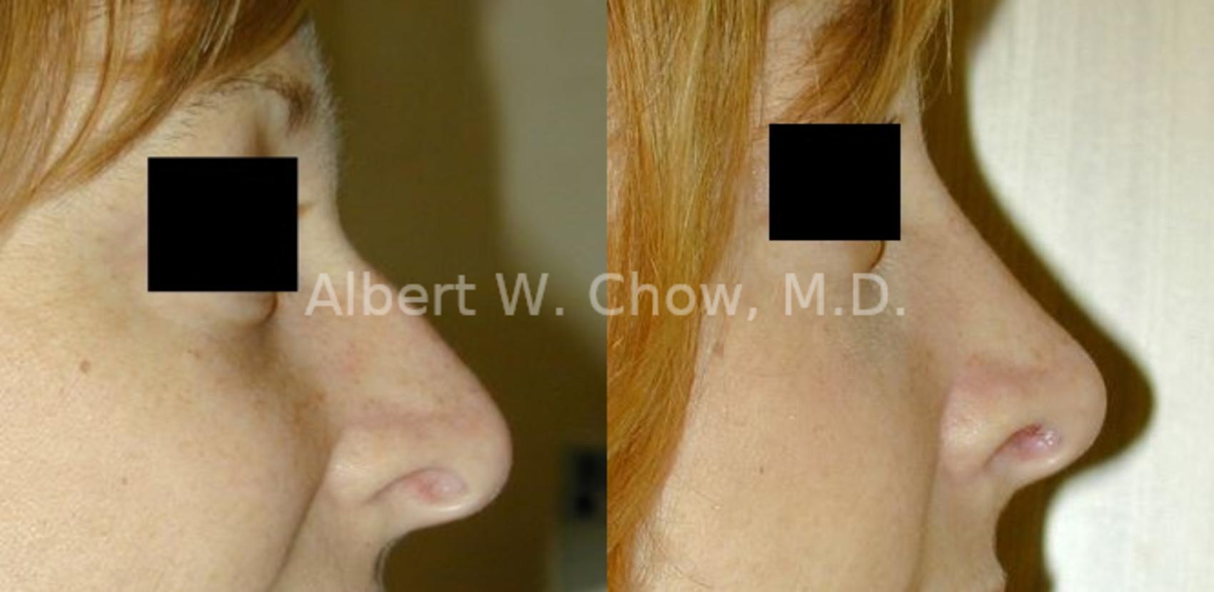 Before & After Rhinoplasty Case 52 View #1 View in San Francisco, CA
