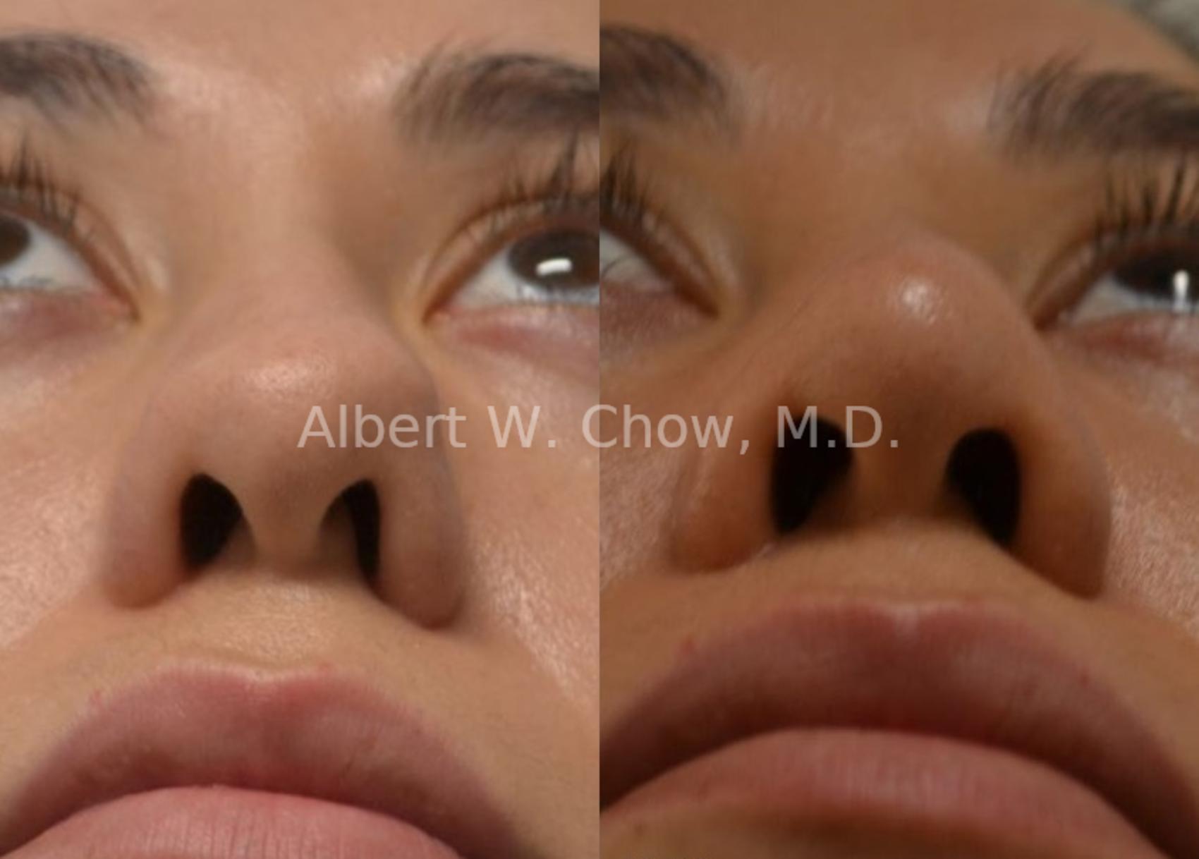 Before & After Rhinoplasty Case 62 View #1 View in San Francisco, CA