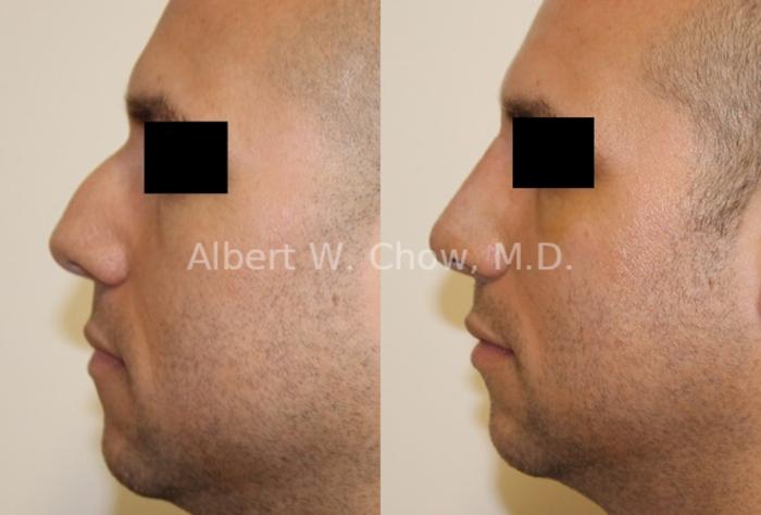 Before & After Rhinoplasty Case 74 View #1 View in San Francisco, CA