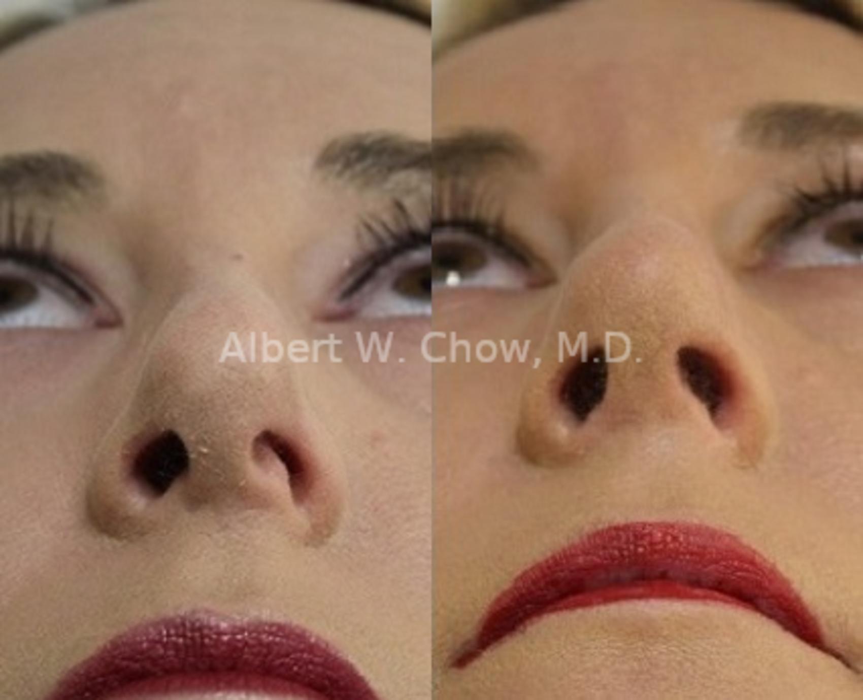 Before & After Rhinoplasty Case 95 View #1 View in San Francisco, CA