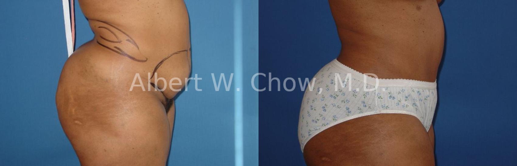 Before & After Tummy Tuck (Abdominoplasty) Case 40 View #1 View in San Francisco, CA