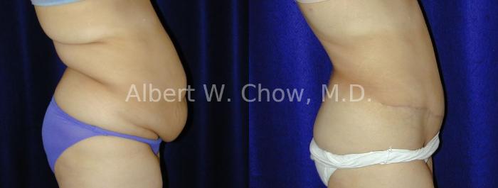 Before & After Tummy Tuck (Abdominoplasty) Case 41 View #1 View in San Francisco, CA