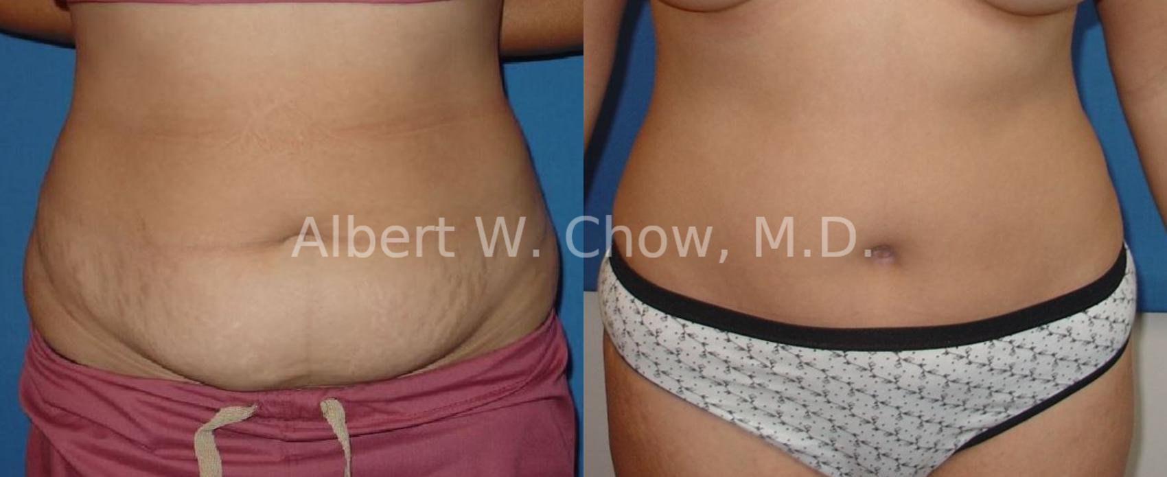 Before & After Tummy Tuck (Abdominoplasty) Case 42 View #1 View in San Francisco, CA