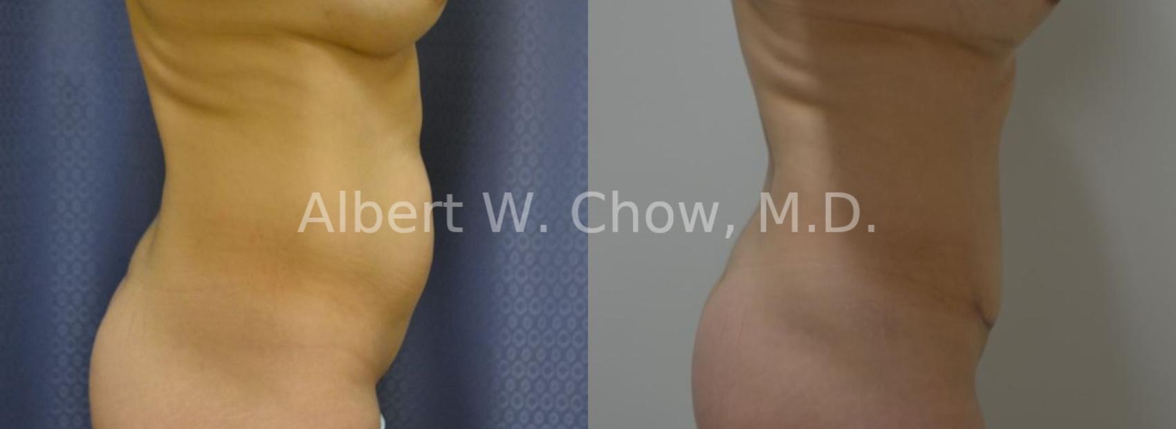 Before & After Liposuction Case 43 View #1 View in San Francisco, CA