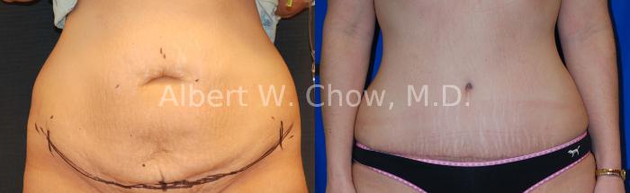 Before & After Tummy Tuck (Abdominoplasty) Case 5 View #1 View in San Francisco, CA