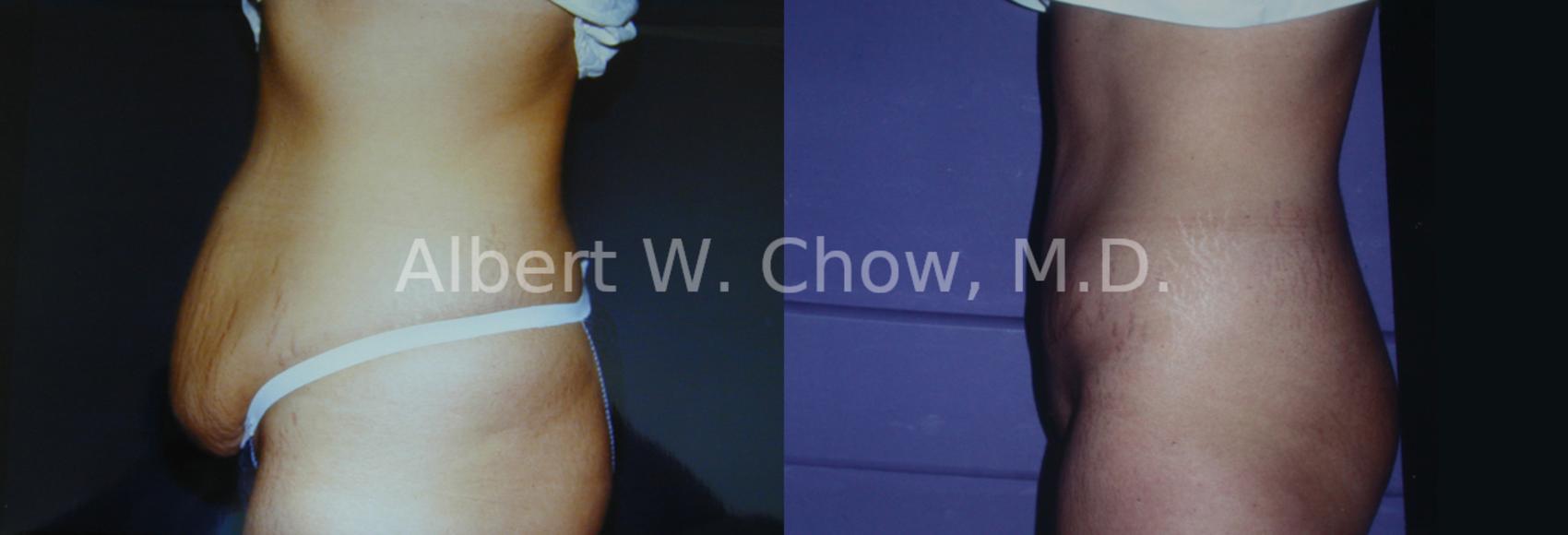 Before & After Tummy Tuck (Abdominoplasty) Case 6 View #1 View in San Francisco, CA
