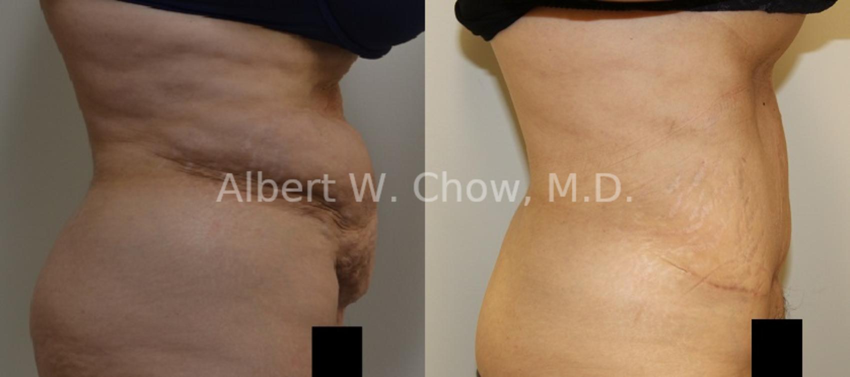Before & After Tummy Tuck (Abdominoplasty) Case 84 View #1 View in San Francisco, CA